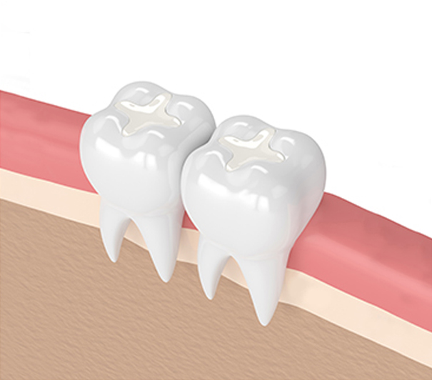 tooth filling