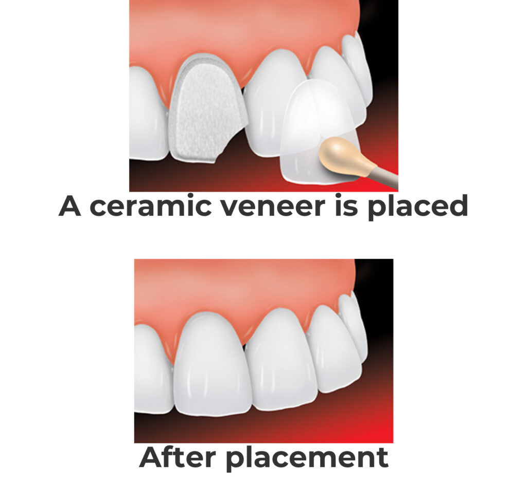 Porcelain Veneers Before and After example