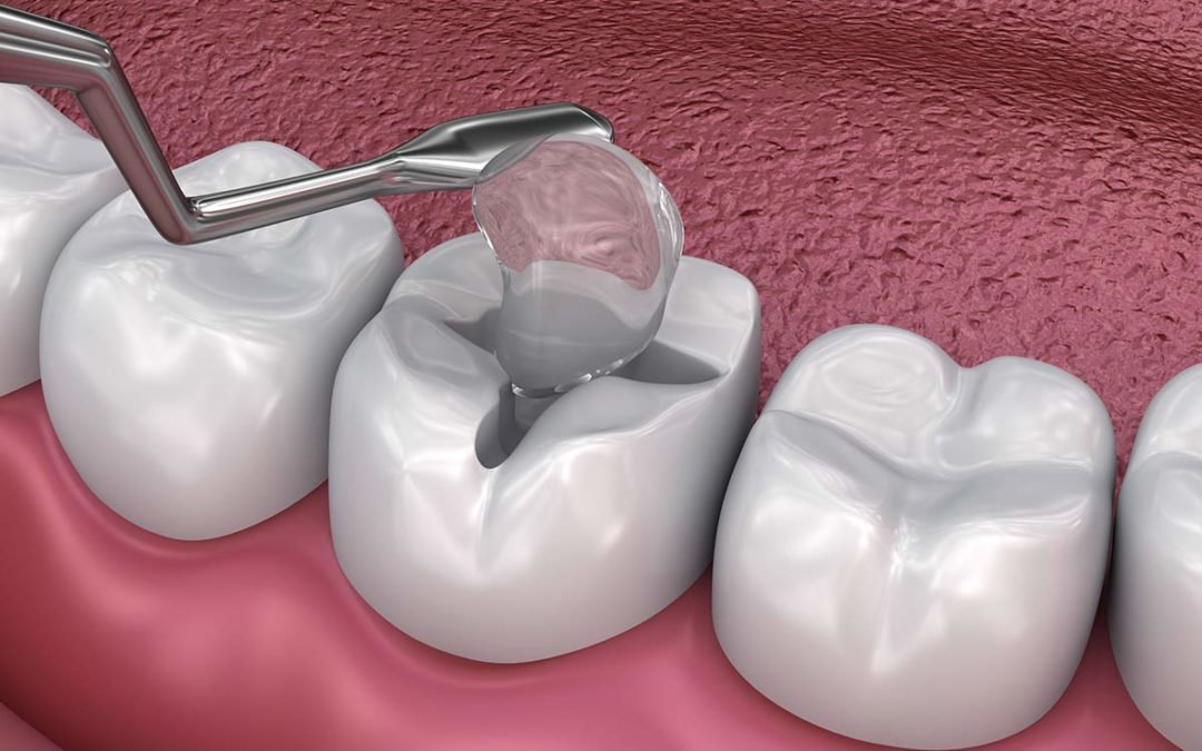 dental fillings 1080x675 1