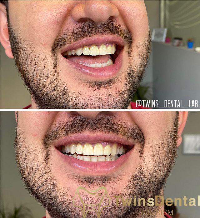 Before & After