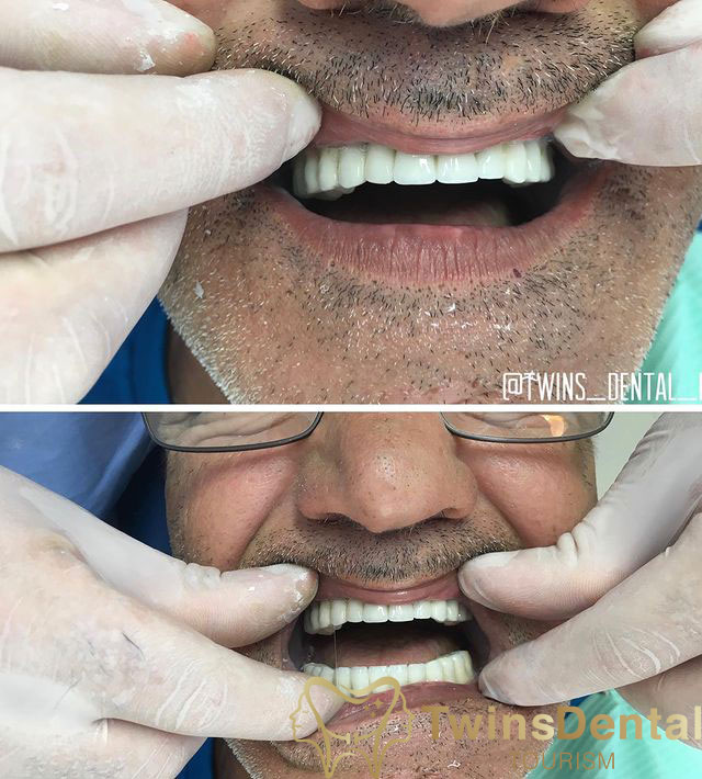 Before & After